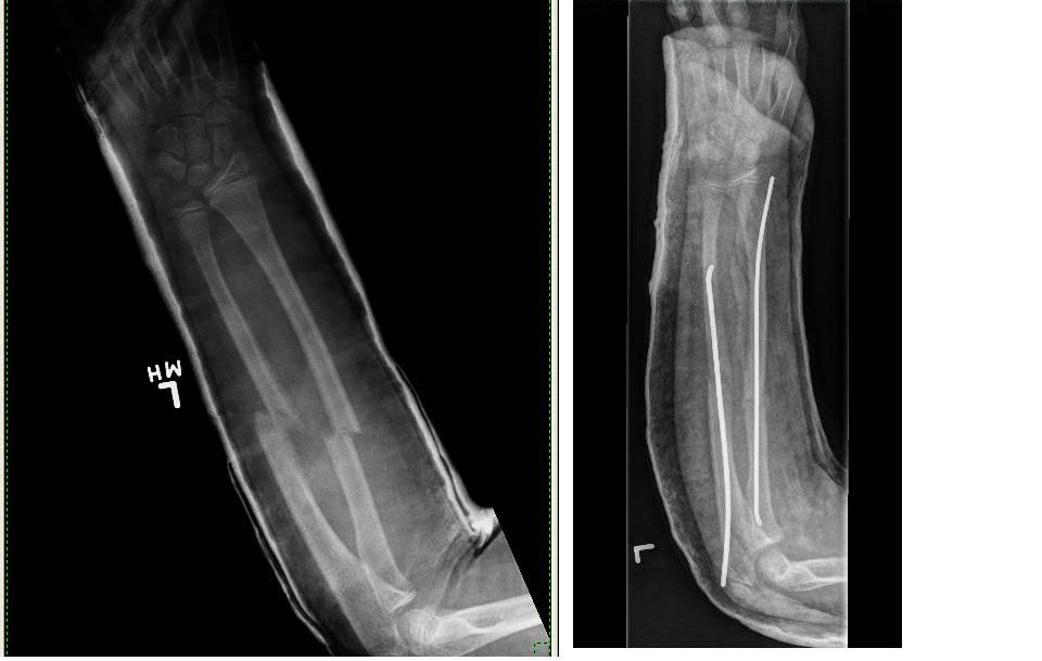 Subdermal Armor biohack.me